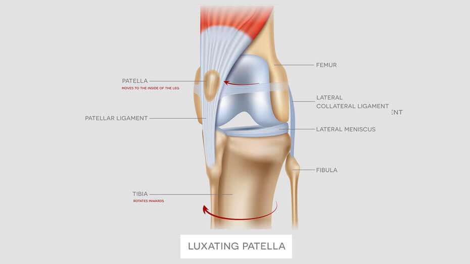 Leg patella best sale